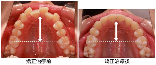 口ゴボ治療前